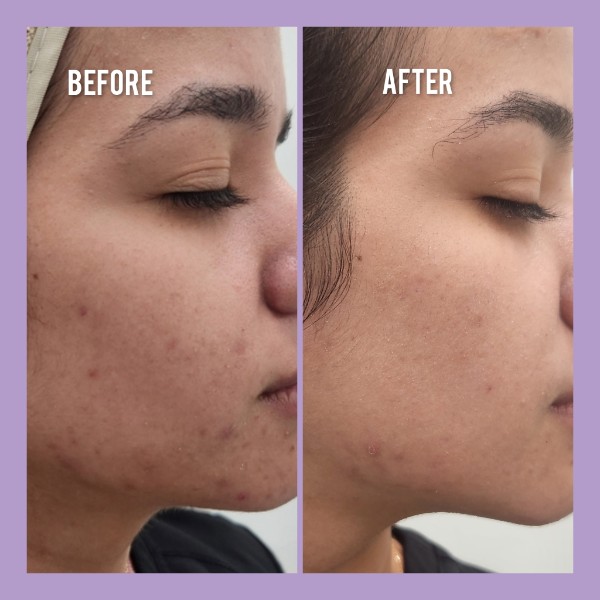 Sophiesticated Esthetics, Acne Treatment in Miami, FL - photo 1