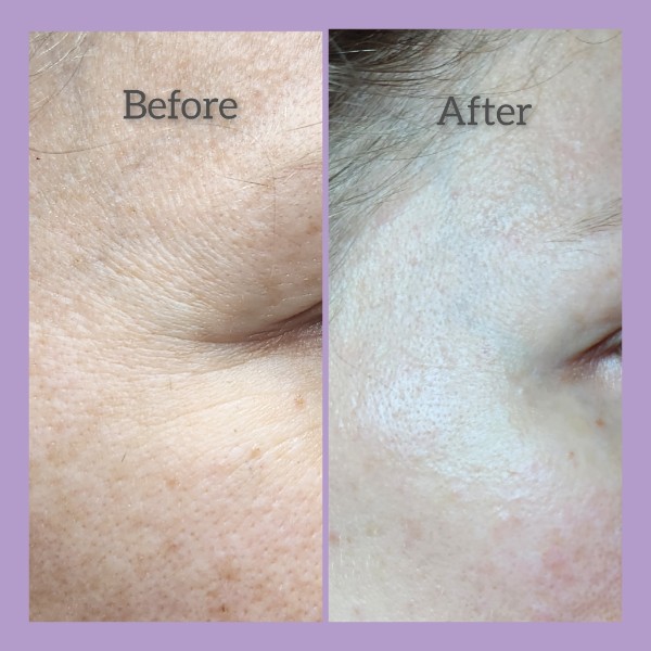 Sophiesticated Esthetics, Acne Treatment in Miami, FL - photo 4