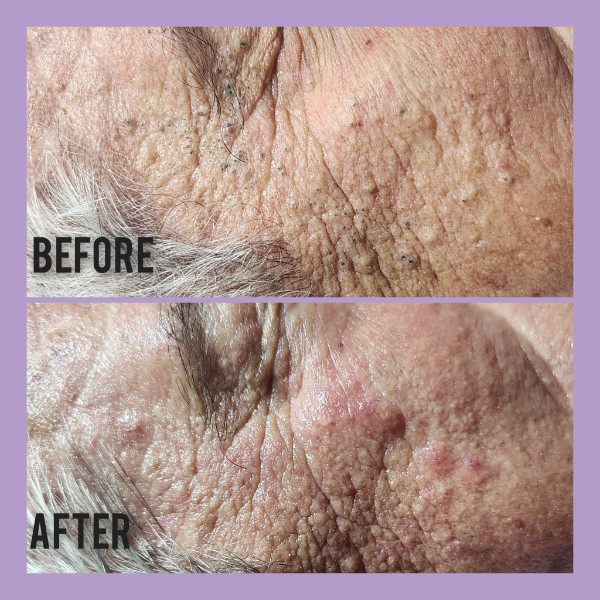Sophiesticated Esthetics, Acne Treatment in Miami, FL - photo 6