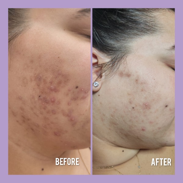 Sophiesticated Esthetics, Acne Treatment in Miami, FL - photo 7