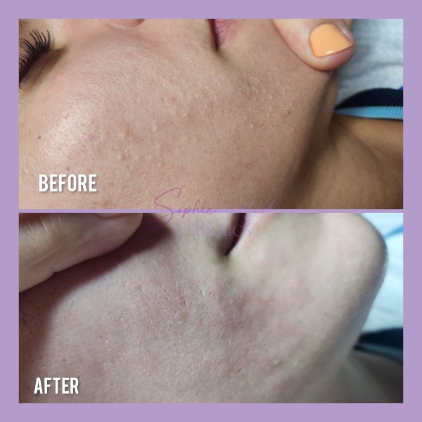 Sophiesticated Esthetics, Acne Treatment in Miami, FL - photo 8