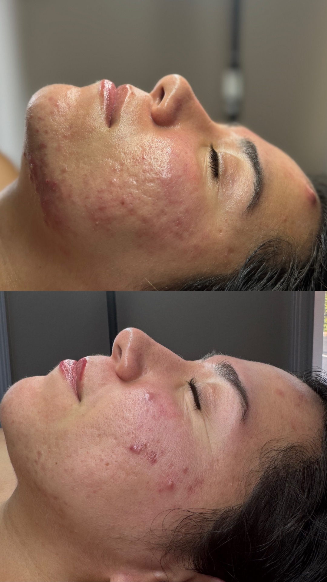 Skye Esthetics, Acne Treatment in Nesconset, NY - photo 6