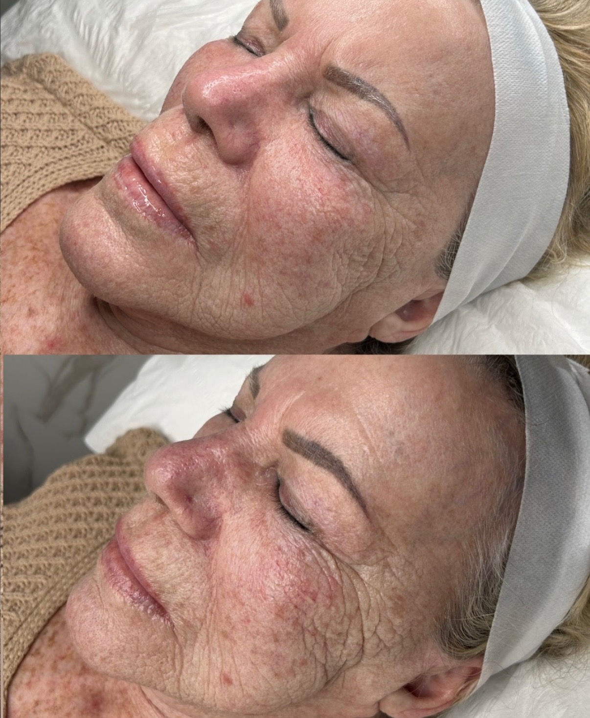 Premier Aesthetics, Acne Treatment in Las Vegas, NV - photo 7