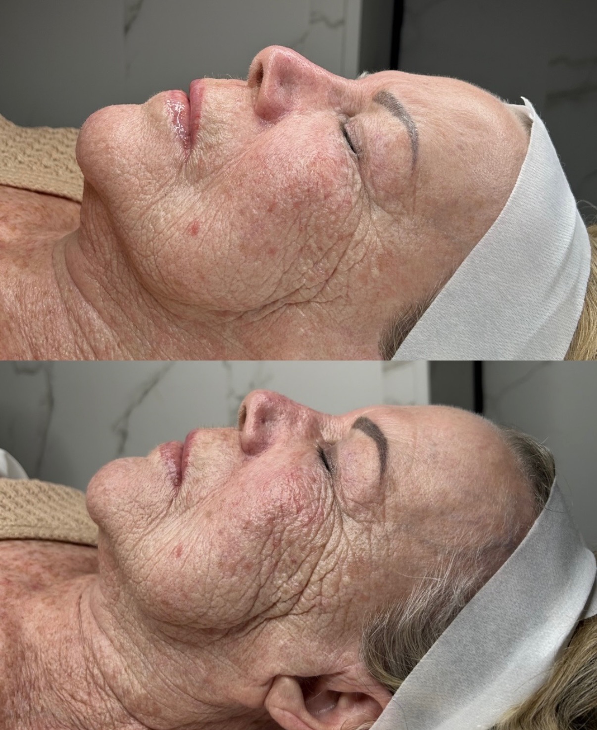 Premier Aesthetics, Acne Treatment in Las Vegas, NV - photo 8